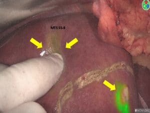 l'evidente colorante – verde di indocianina