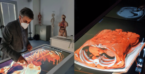 Il prof Bruno Nardo al tavolo anatomico 3D nella simulazione preoperatoria di un paziente con voluminoso tumore del fegato